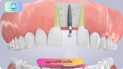  کاشت ایمپلنت برای دندان جلو |سلامت کاشت درین