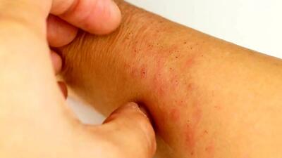  بیماری ایدز و HIV / جدول آخرین دستاوردهای درمانی بیماری ایدز در جهان