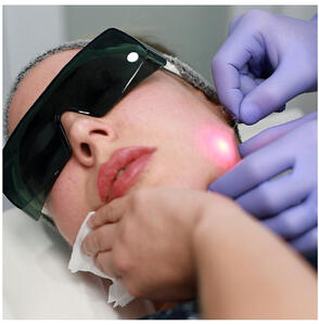  لیفت صورت با دستگاه اندولیفت یوفوتون