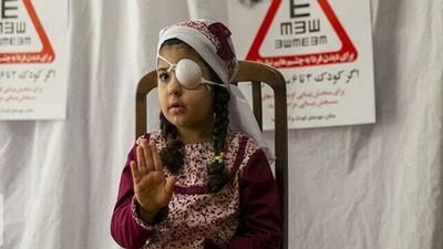  نرخ شیوع تنبلی چشم در ایران کمتر از میانگین جهانی است