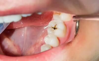  سلامت دهان و دندان چگونه می‌تواند خطر سکته مغزی و مشکلات قلبی را کاهش دهد؟