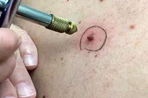  ابتلا به زگیل تناسلی  به 17 سال رسید/ تصمیم گیری آموزش و پرروش و وزارت بهداشت برای واکسن گارداسیل دانش آموزان روی هواست/  نوجوانان در معرض خطر خاموش!