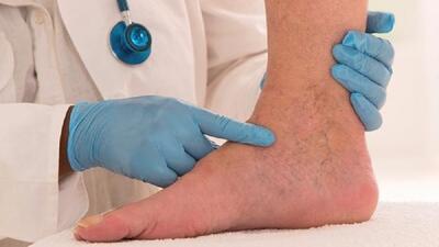 با چند عادت ساده از ابتلا به واریس پیشگیری کنیم