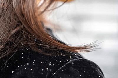  اگر شوره دارید، شب‌ها این کار ساده را فراموش نکنید!