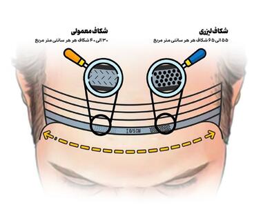  انقلاب لیزری در کاشت مو؛ حقیقتی تازه یا دروغ تبلیغاتی؟!