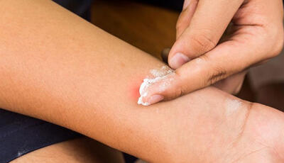  پماد کالامین ۸ درصد برای چیست؟‌ نحوه مصرف،‌ عوارض و نکاتی که باید بدانید