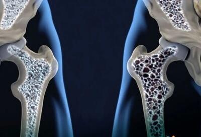  با مصرف این ویتامین‌ها استخوان‌های خود را تقویت کنید