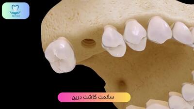  کاشت ایمپلنت دندان برای فک بالا | سلامت کاشت درین