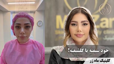  فرم‌دهی و جوانسازی صورت ( کلینیک زیبایی ماه زر )
