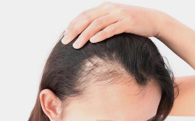  چند فرمول خانگی مؤثر برای تقویت و کاهش ریزش موها