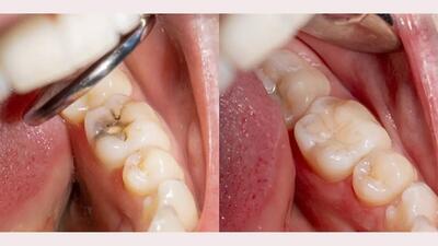  معرفی جدیدترین مواد ترمیمی دندان با استحکام فولاد + زیبایی الماس