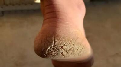  فواید ترک پاشنه پا چیست؟