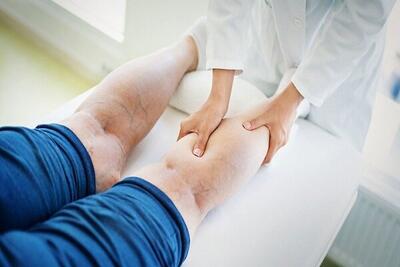  پیشگیری از ابتلا به واریس با چند عادت ساده