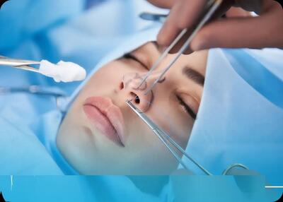  جراحی بینی بدون بیهوشی توسط دستیار دیپلمه پزشک