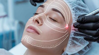  لیفت صورت بدون جراحی با لیزر اندولیفت با ماندگاری طولانی -دکتر پونه یزدانی متخصص پوست