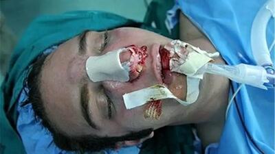  جراحی بینی بدون بیهوشی توسط جوان دیپلمه / مدعی 3 هزار جراحی موفقیت آمیز است