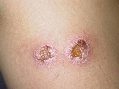  نخستین باند تخصصی درمان زخم سالک توسط محققان کاشانی تولید شد