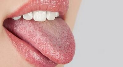  تشخیص بیماری از روی رنگ زبان (فیلم)