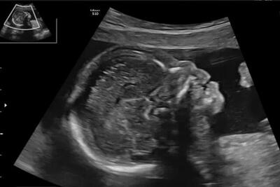  آیا تشخیص زودهنگام «سندرم داون» با شاخص استخوان بینی ممکن است؟