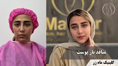  منافذ باز پوست فقط یک مشکل ظاهری نیست ( کلینیک زیبایی ماه زر )