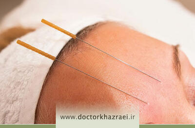  طب سوزنی برای میگرن؛ روشی طبیعی و بی‌عارضه برای کنترل سردردهای میگرنی