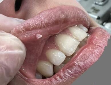  عکس: زگیل تناسلی در دهان بیمار ۱۷ ساله