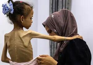  سوء تغذیه در غزه از ۹۰ درصد فراتر رفته است