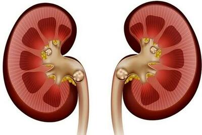  شایع‌ترین دلیل ایجاد سنگ کلیه رسوب املاح در کلیه است