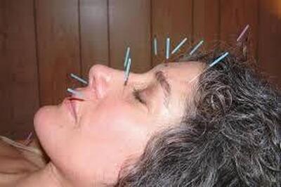  طب سوزنی برای میگرن؛ روشی طبیعی و بی‌عارضه برای کنترل سردردهای میگرنی