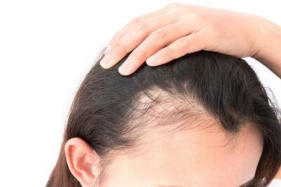  راه حل‎‌های ساده برای درمان ریزش موی شقیقه‌ها