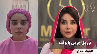  این روزها همه از گرونی فیلرها حرف می‌زنن