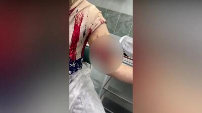  ملوان زبل روسی در آستانه قطع هر دو دست