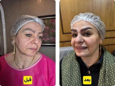  کاشت ابرو بدون جراحی به روش سلبریتی متد