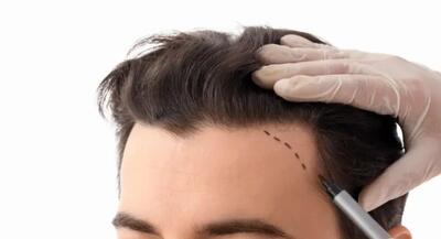  شوک ریزش بعد از کاشت مو: کابوس موقت یا شکست دائمی؟