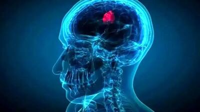  تحولی در درمان سرطان مغز با قطره‌ بینی ویژه