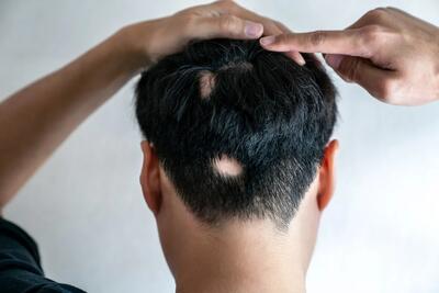  آیا در حال کچل شدن هستید؟ از این هوش مصنوعی بپرسید