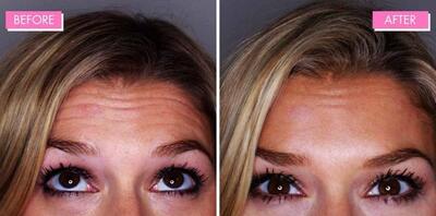  ۸ توصیه برای بوتاکس اولی‌ها که باید بدانید