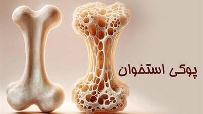 پوکی استخوان در کودکان، واقعیتی فراموش‌شده