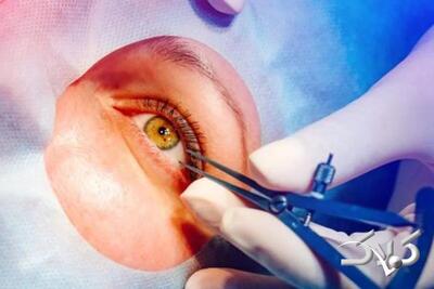  انجام سالانه ۷۰۰۰ عمل پیوند قرنیه در ایران | تنها ۱۵ درصد خانواده‌ها اجازه اهدای قرنیه می‌دهند - مجله اینترنتی کولاک