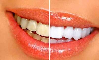  لمینت دندان جلو چگونه انجام می‌شود و چه مزایایی دارد؟