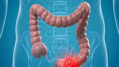  چرا دلیل یبوست اهمیت دارد؟