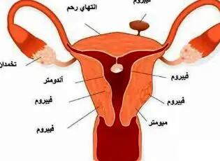  مهمترین دانستنی ها در مورد فیبروم رحمی!