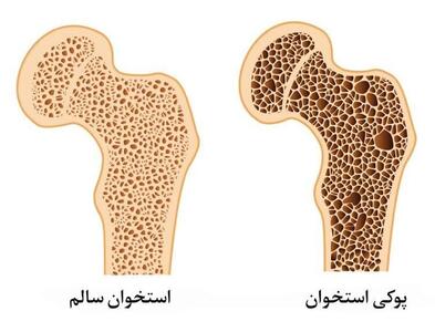  درباره استئوپروز چه می‌دانید؟ | شیوع نوعی پوکی استخوان در کودکان
