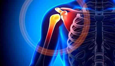  شانه یخ‌زده چیست؟