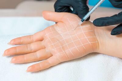  مزایا و مدت ماندگاری بوتاکس کف دست