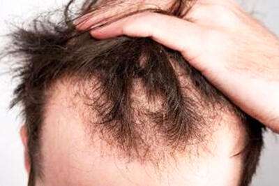  اگر در خطر ریزش مو هستید، از این هوش مصنوعی بپرسید!