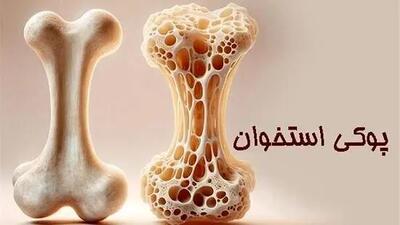  وقتی کودکان دچار پوکی  می‌شوند؛ واقعیتی که باید جدی گرفته شود