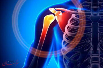  شانه یخ‌زده چیست؟