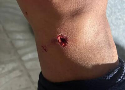  تصویر ترسناک از زانوی سوراخ شده بازیکن آلومینیوم!