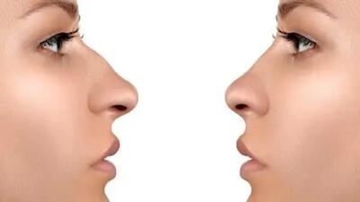  خبر خیلی خوب برای آنهایی که قوز بینی دارند!